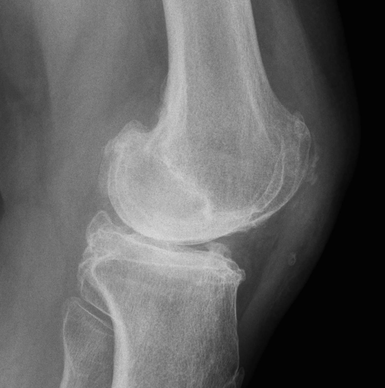 Patellectomy Lateral